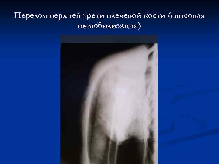 Перелом верхней трети плечевой кости (гипсовая иммобилизация) 
