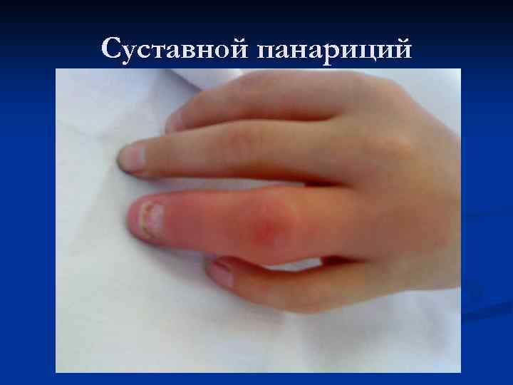 Суставной панариций 