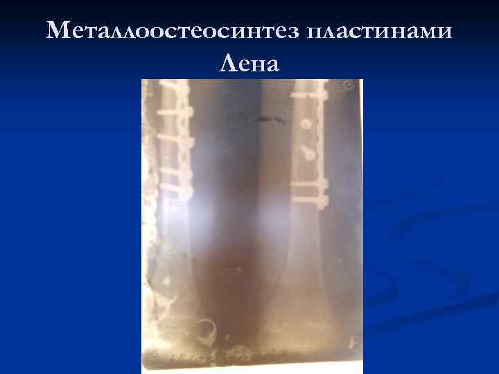 Металлоостеосинтез пластинами Лена 