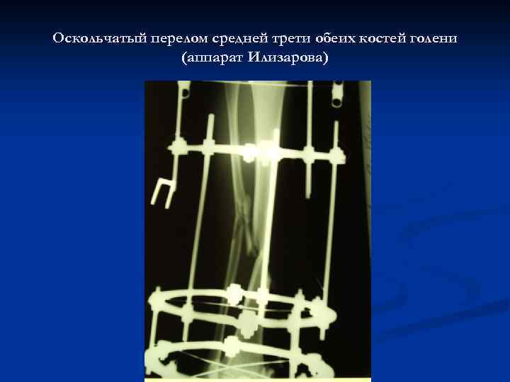 Оскольчатый перелом средней трети обеих костей голени (аппарат Илизарова) 