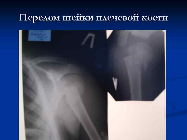 Перелом шейки плечевой кости 