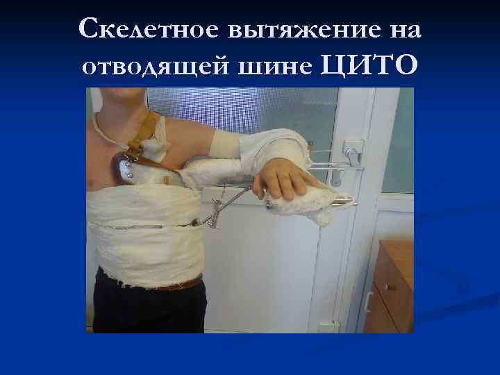 Скелетное вытяжение на отводящей шине ЦИТО 