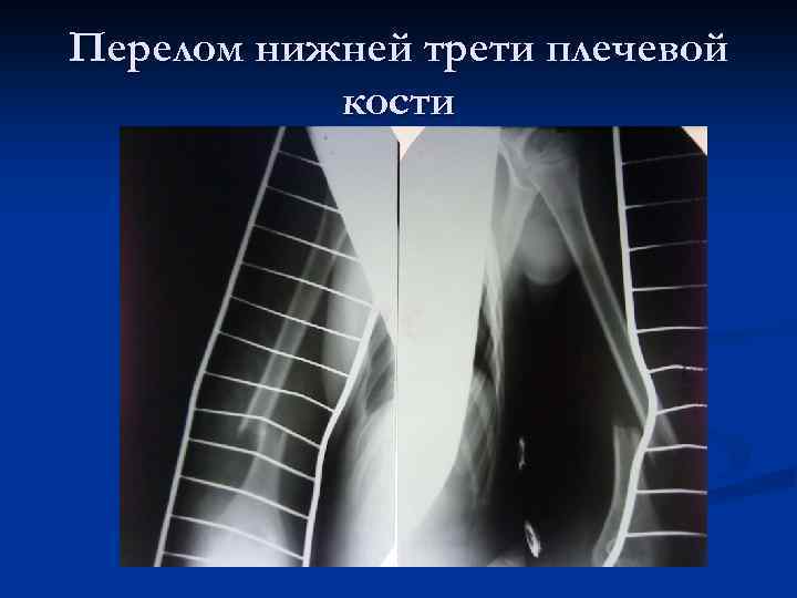 Перелом нижней трети плечевой кости 
