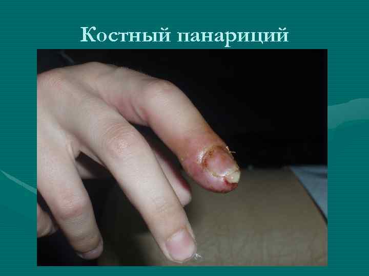 Костный панариций 
