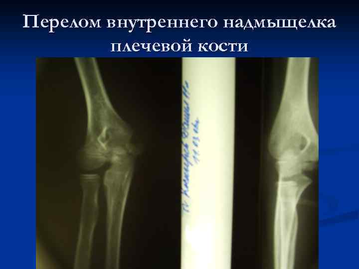 Перелом внутреннего надмыщелка плечевой кости 