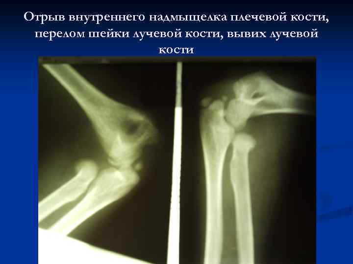 Отрыв внутреннего надмыщелка плечевой кости, перелом шейки лучевой кости, вывих лучевой кости 