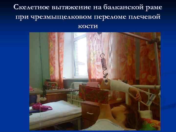 Скелетное вытяжение на балканской раме при чрезмыщелковом переломе плечевой кости 