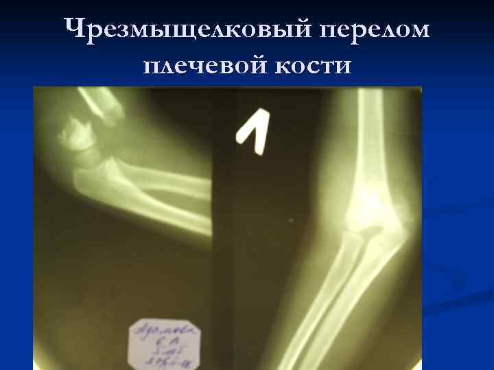 Чрезмыщелковый перелом плечевой кости 