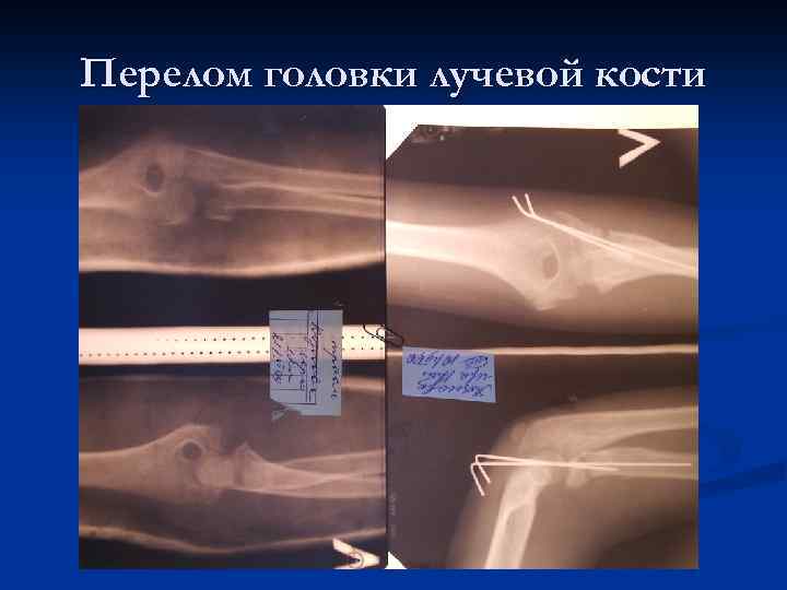 Перелом головки лучевой кости 