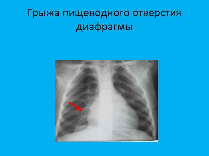 Грыжа пищеводного отверстия диафрагмы 