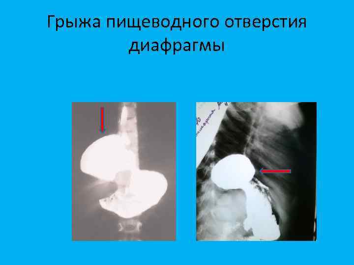 Грыжа пищеводного отверстия диафрагмы 