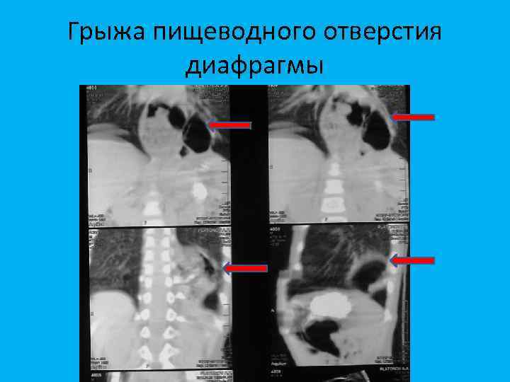 Грыжа пищеводного отверстия диафрагмы 