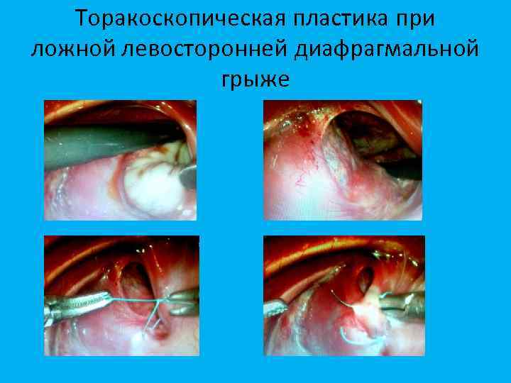 Торакоскопическая пластика при ложной левосторонней диафрагмальной грыже 