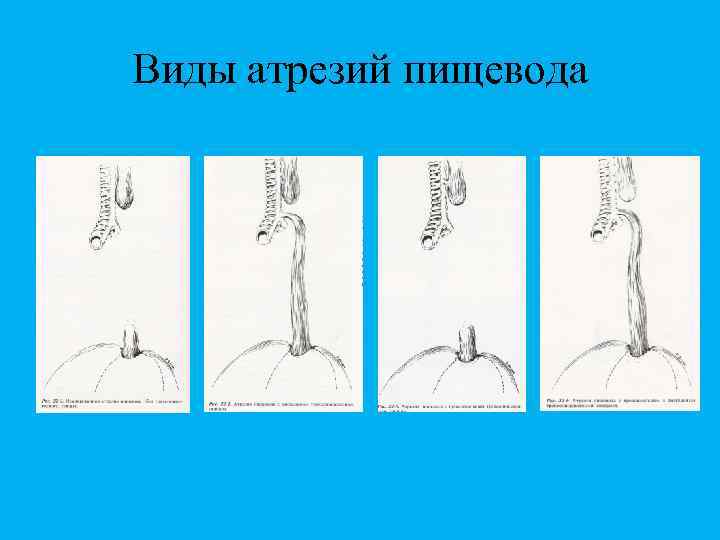 Виды атрезий пищевода 