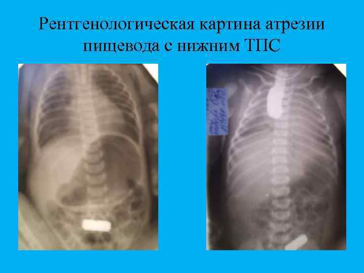 Рентгенологическая картина атрезии пищевода с нижним ТПС 