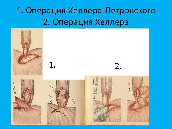 1. Операция Хеллера-Петровского 2. Операция Хеллера 1. 2. 