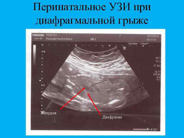 Перинатальное УЗИ при диафрагмальной грыже Желудок Диафрагма 