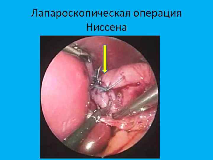 Лапароскопическая операция Ниссена 