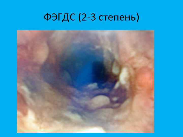 ФЭГДС (2 -3 степень) 