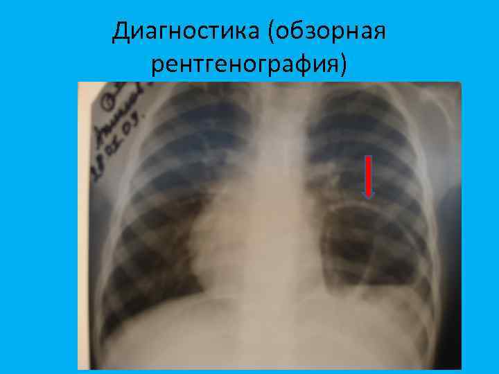 Диагностика (обзорная рентгенография) 