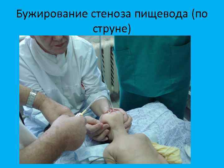 Бужирование стеноза пищевода (по струне) 