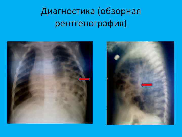 Диагностика (обзорная рентгенография) 