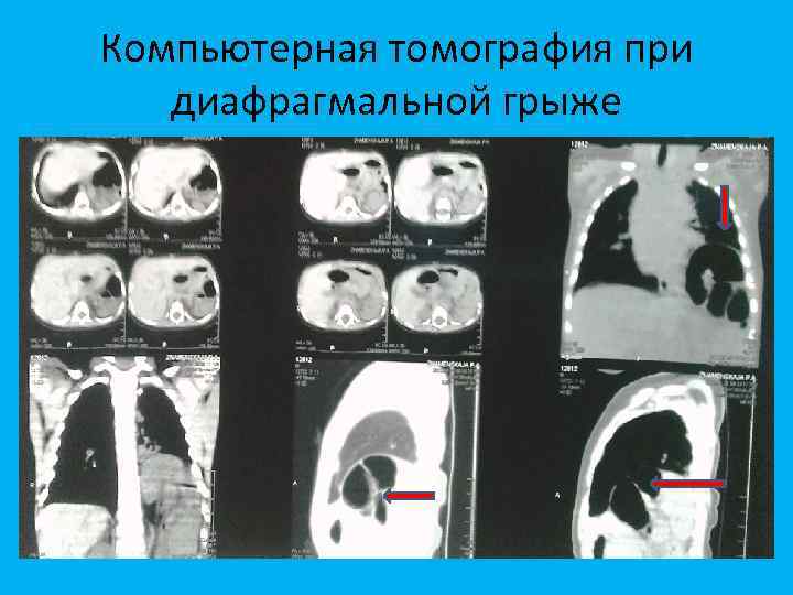 Компьютерная томография при диафрагмальной грыже 