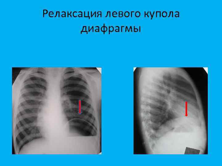 Релаксация левого купола диафрагмы 