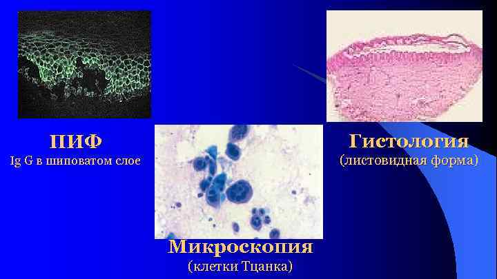 Гистология ПИФ (листовидная форма) Ig G в шиповатом слое Микроскопия (клетки Тцанка) 