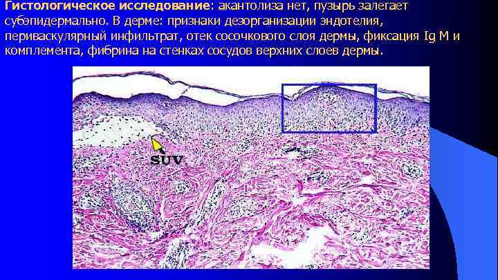 Гистологическое исследование: акантолиза нет, пузырь залегает субэпидермально. В дерме: признаки дезорганизации эндотелия, периваскулярный инфильтрат,