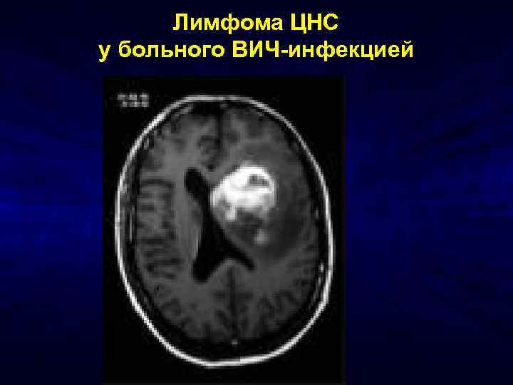 Лимфома ЦНС у больного ВИЧ-инфекцией 
