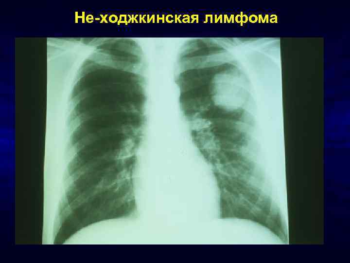 Не-ходжкинская лимфома 
