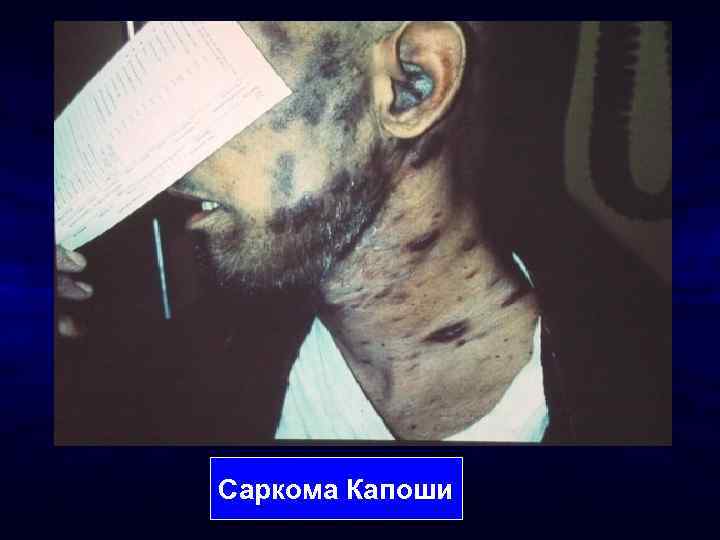 Саркома Капоши 