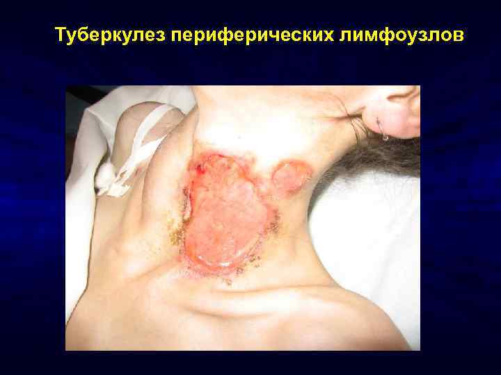 Туберкулез периферических лимфоузлов 