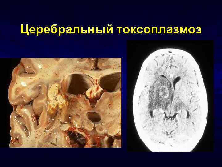 Церебральный токсоплазмоз 