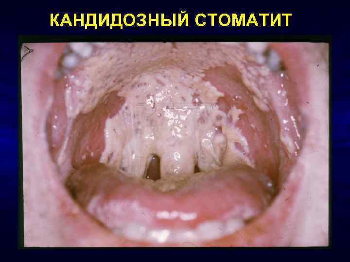 КАНДИДОЗНЫЙ СТОМАТИТ 