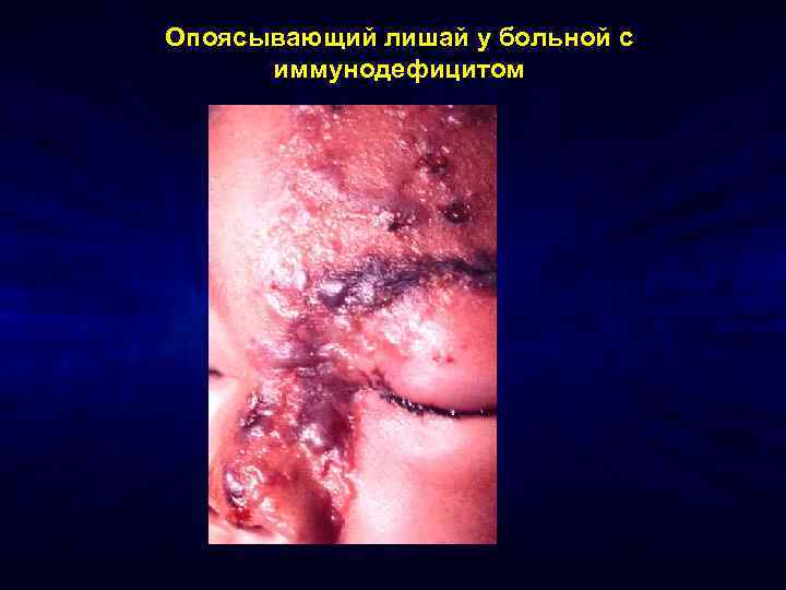 Опоясывающий лишай у больной с иммунодефицитом 