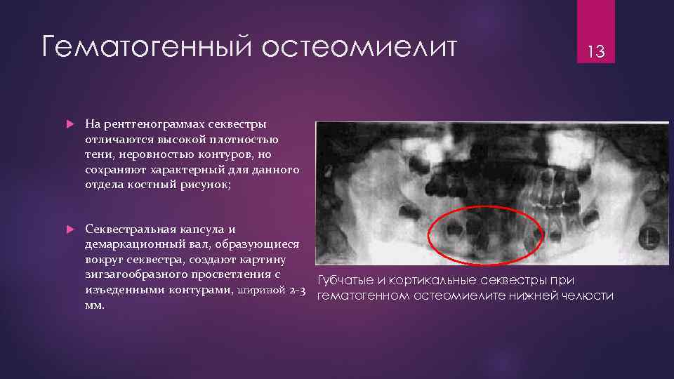Гематогенный остеомиелит 13 На рентгенограммах секвестры отличаются высокой плотностью тени, неровностью контуров, но сохраняют