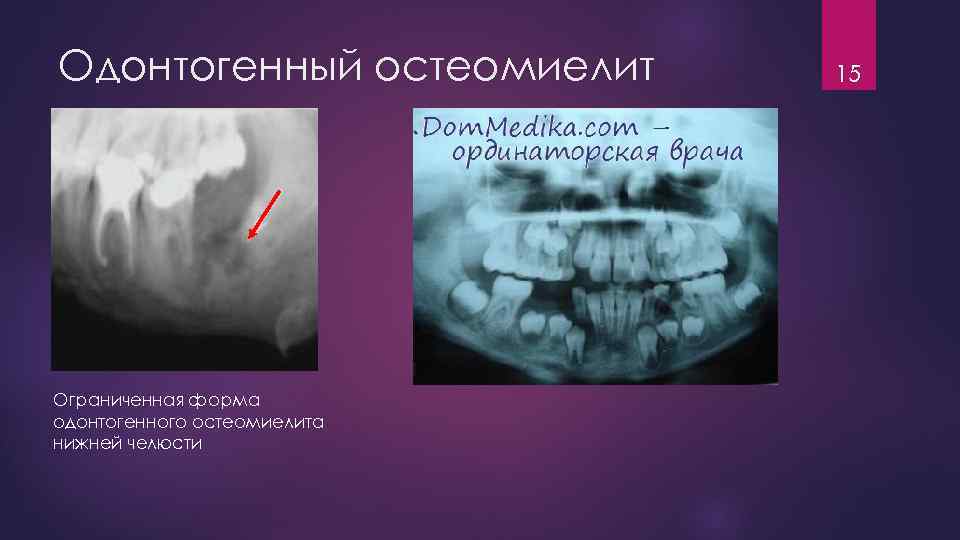Одонтогенный остеомиелит Ограниченная форма одонтогенного остеомиелита нижней челюсти 15 