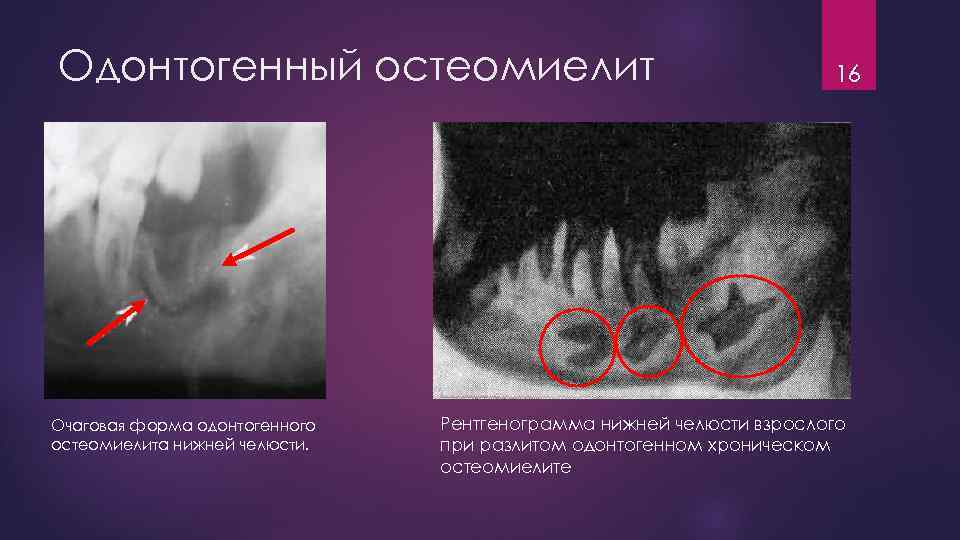 Остеомиелит нижней челюсти фото