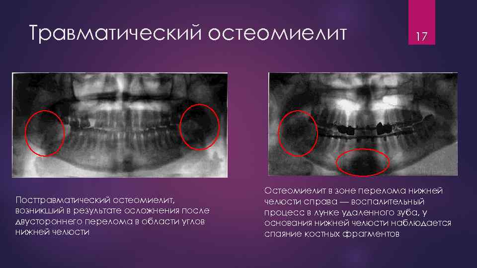 Травматический остеомиелит Посттравматический остеомиелит, возникший в результате осложнения после двустороннего перелома в области углов
