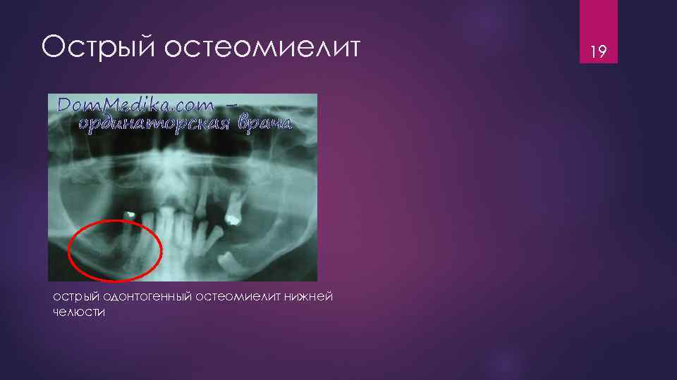 Острый остеомиелит острый одонтогенный остеомиелит нижней челюсти 19 