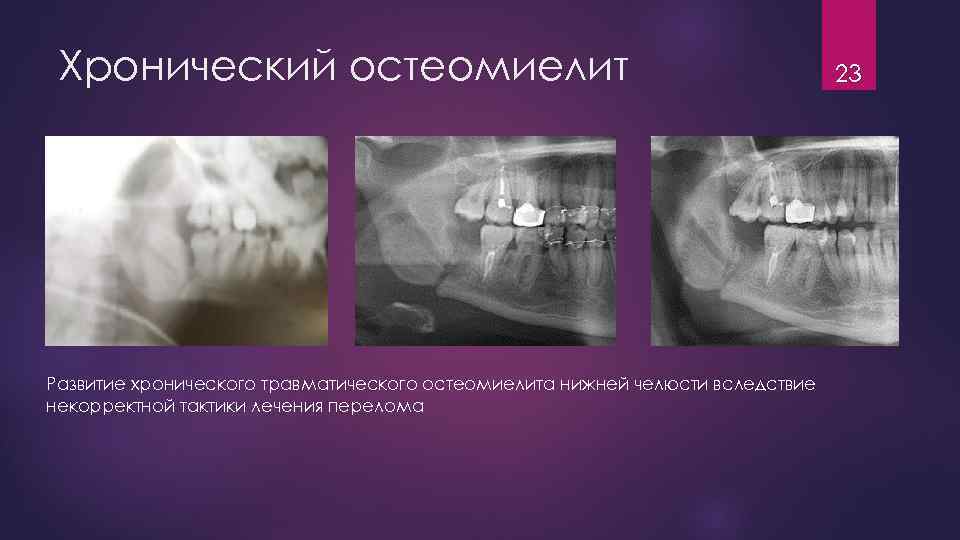 Хронический остеомиелит Развитие хронического травматического остеомиелита нижней челюсти вследствие некорректной тактики лечения перелома 23
