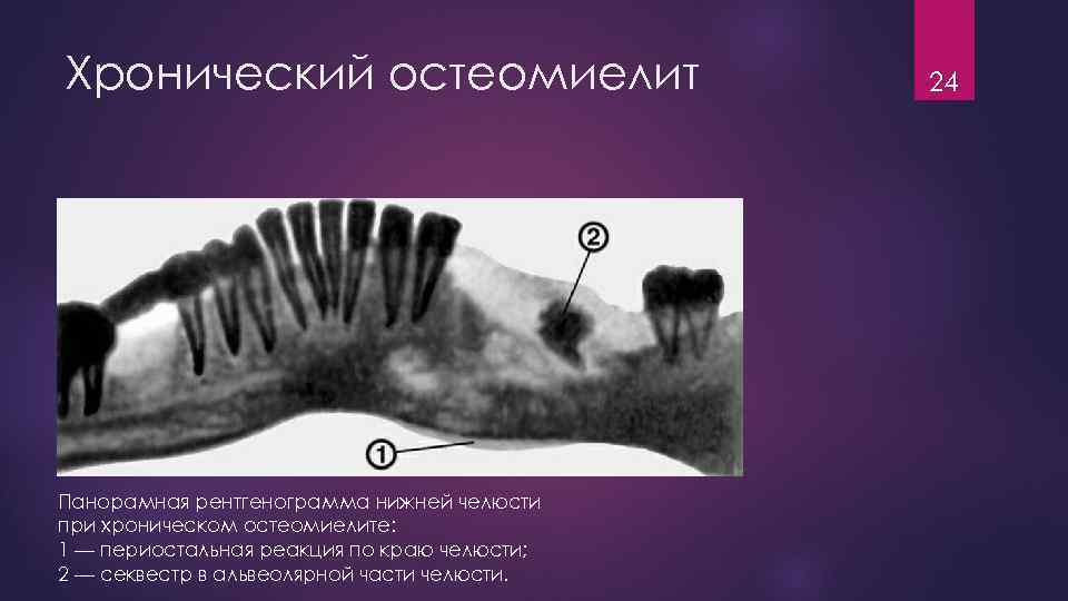 Хронический остеомиелит Панорамная рентгенограмма нижней челюсти при хроническом остеомиелите: 1 — периостальная реакция по