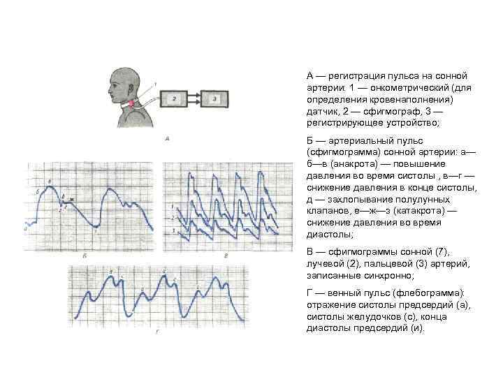 А — регистрация пульса на сонной артерии: 1 — онкометрический (для определения кровенаполнения) датчик,