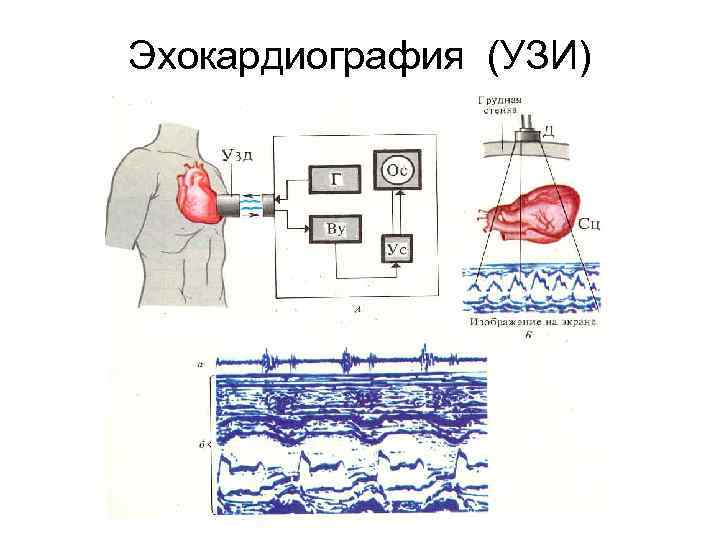 Эхокардиография (УЗИ) 