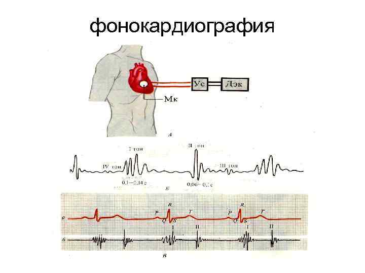 фонокардиография 