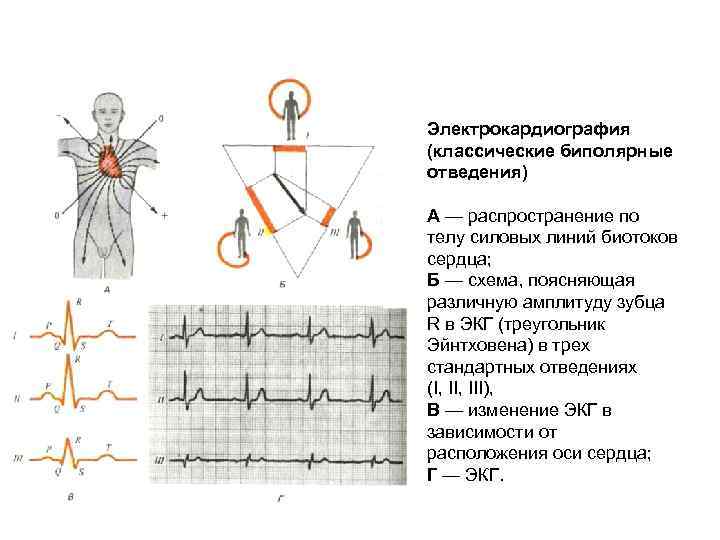 Электрокардиография (классические биполярные отведения) А — распространение по телу силовых линий биотоков сердца; Б