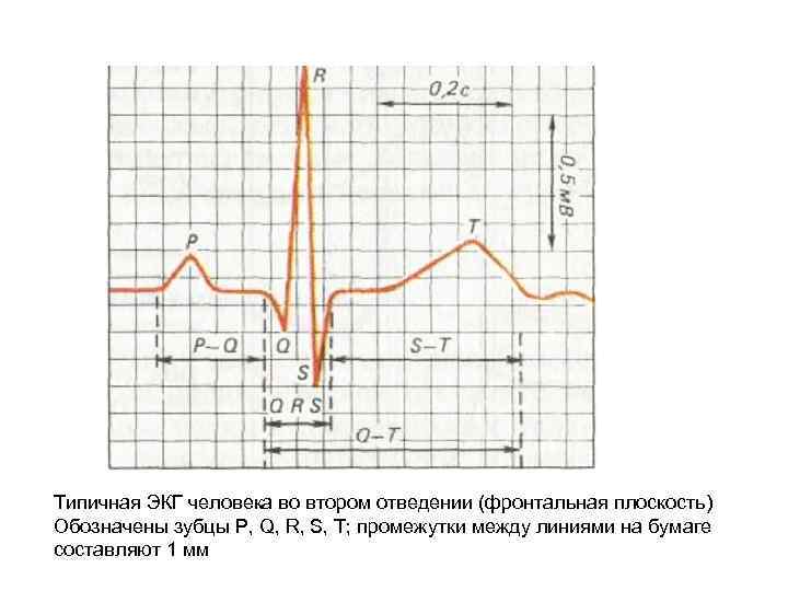 Типичная ЭКГ человека во втором отведении (фронтальная плоскость) Обозначены зубцы Р, Q, R, S,