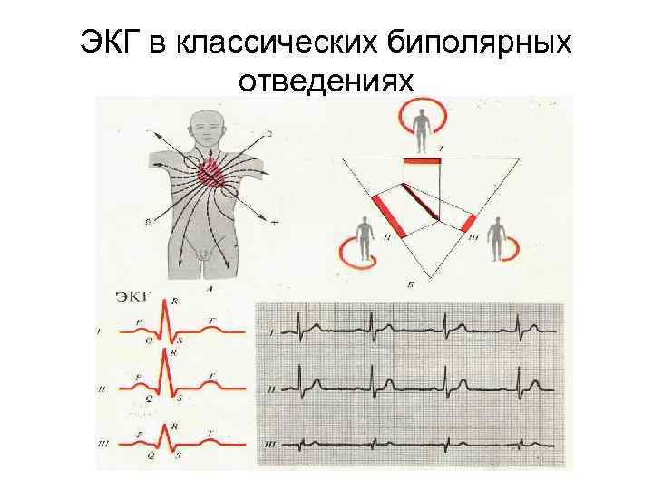 ЭКГ в классических биполярных отведениях 